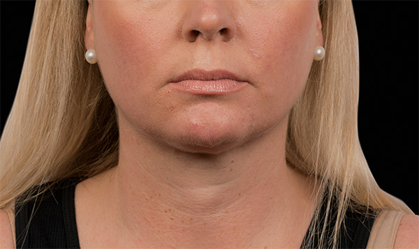 double chin reduction treatment coolsculpting Morristown